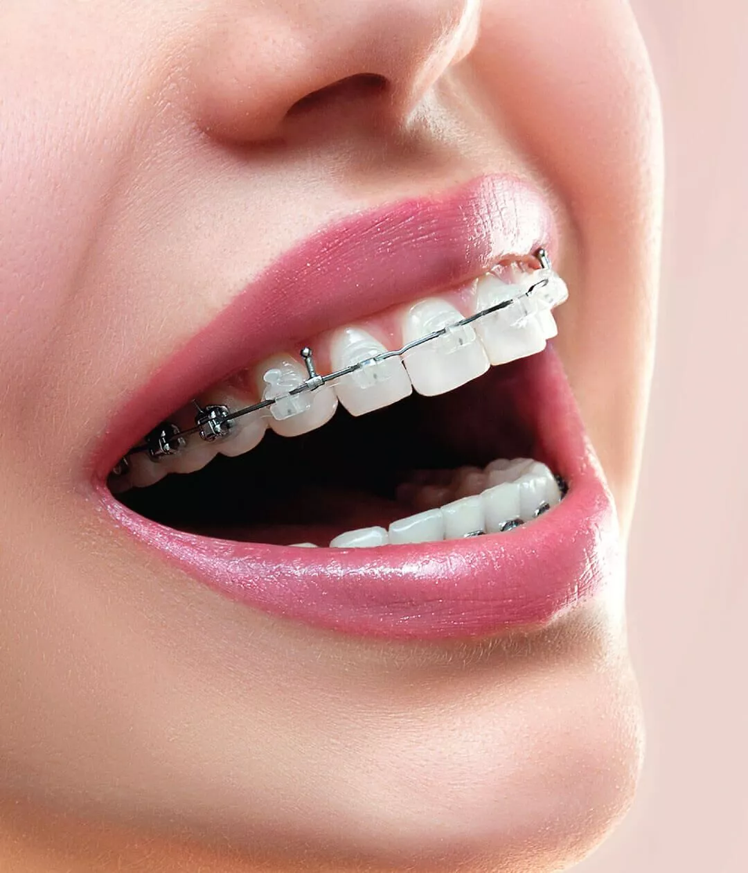 Discreet Straightening With Ceramic Braces ICDE UAE