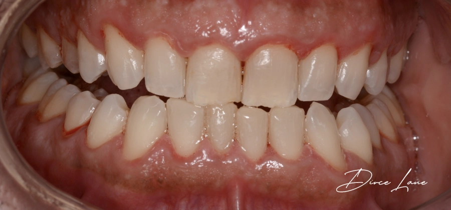 Dirce Cases - After
