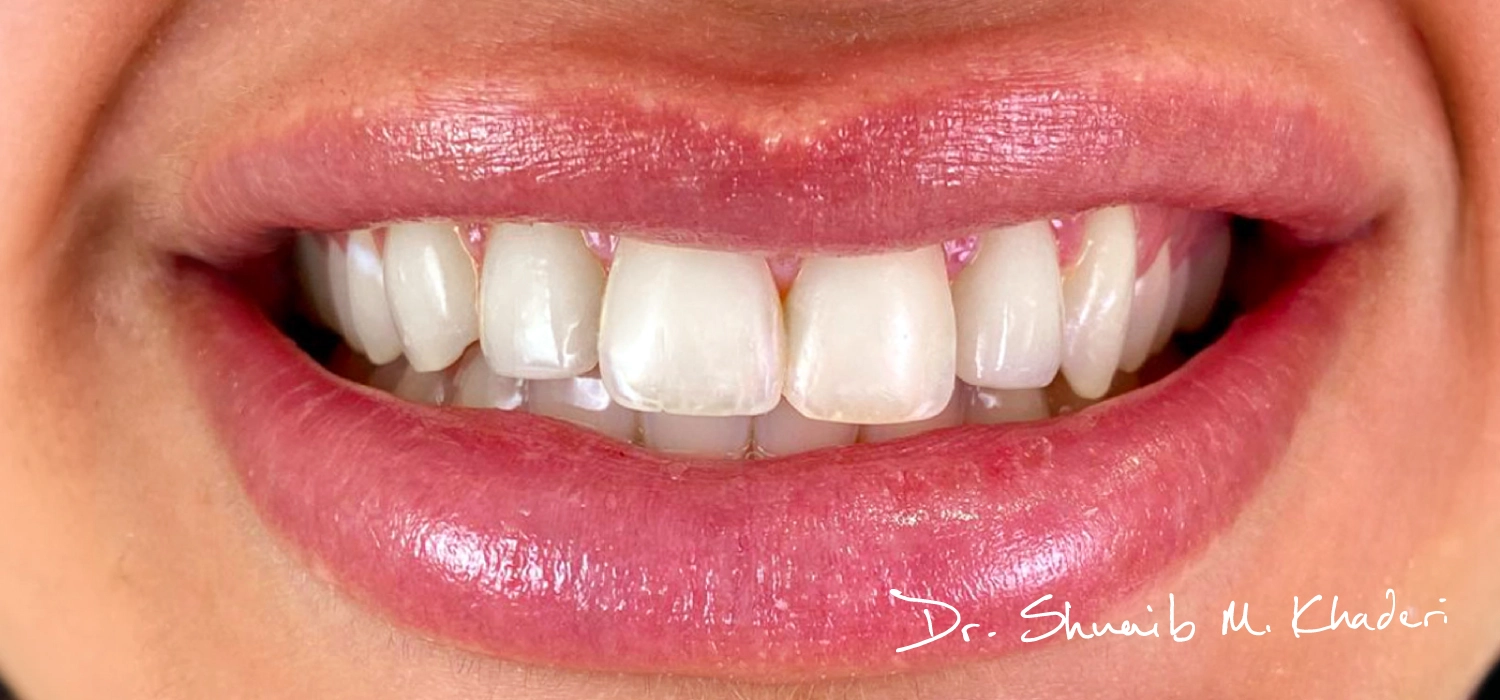 Dr-Shuaib-Veneers-02