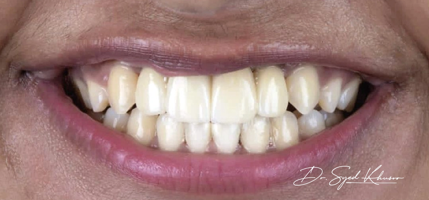 Childhood dental truama-02