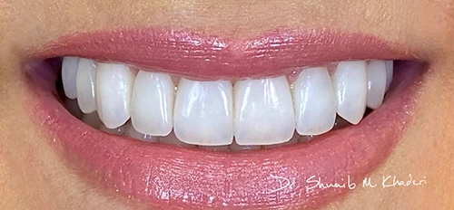 Cosmetic-Veneers-Abu-Dhabi-02