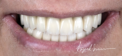 Dental-Crown-Abu-Dhabi-Hollywood-Smile-After-02