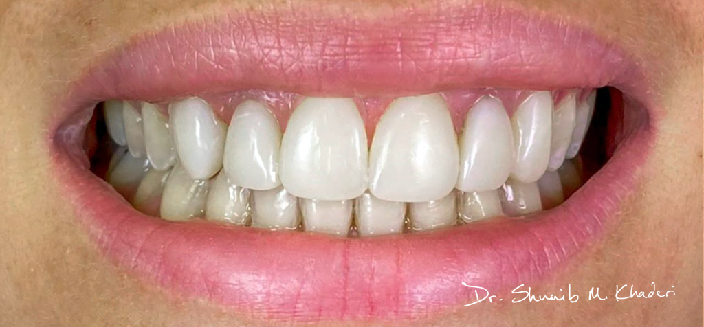 Dental-veneers-Abu-Dhabi-04