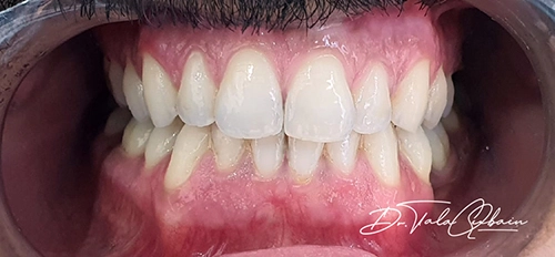 Gum-de-pigmentation-Gum-bleaching-After