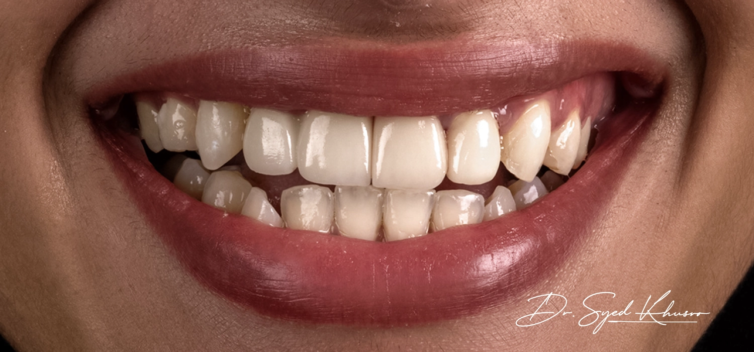 Implant-treatment-04