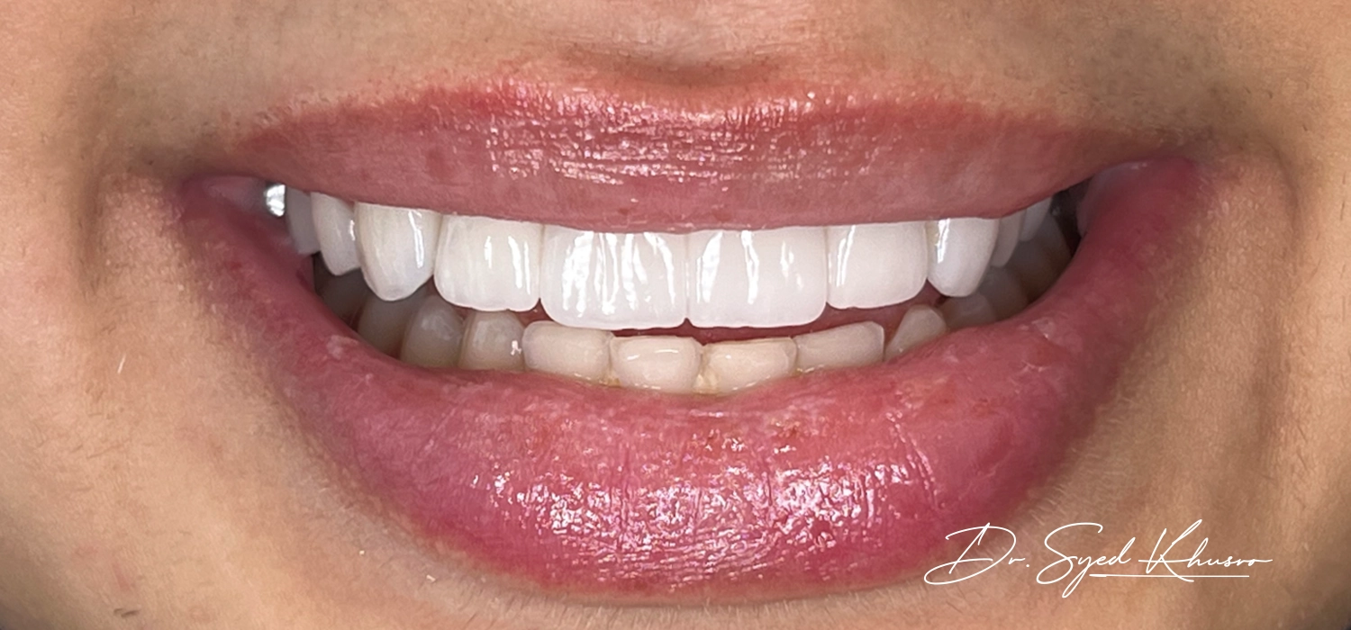 Old Bad Veneers-02