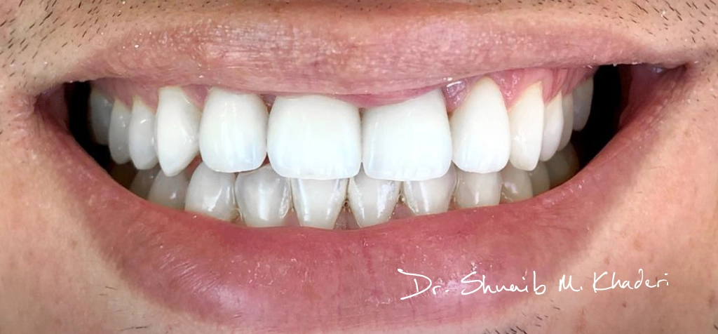 Teeth-cleaning-after