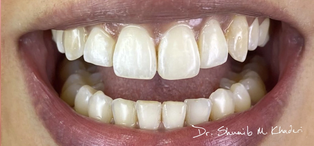 tooth-filling-02
