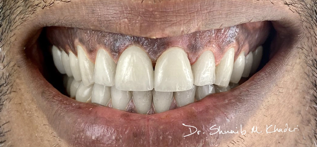 Cosmetic-dentistry-abu-dhabi-After copy