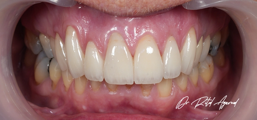 Dr Ritul-Cosmetic Dental Treatment-06