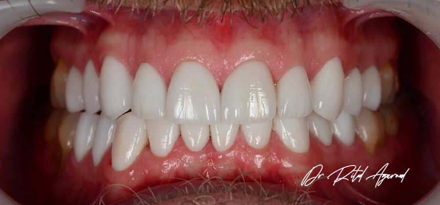 Dr Ritul-Cosmetic Dental Treatment-10