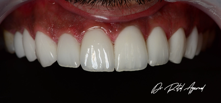 Dr Ritul-Cosmetic Dental Treatment-12