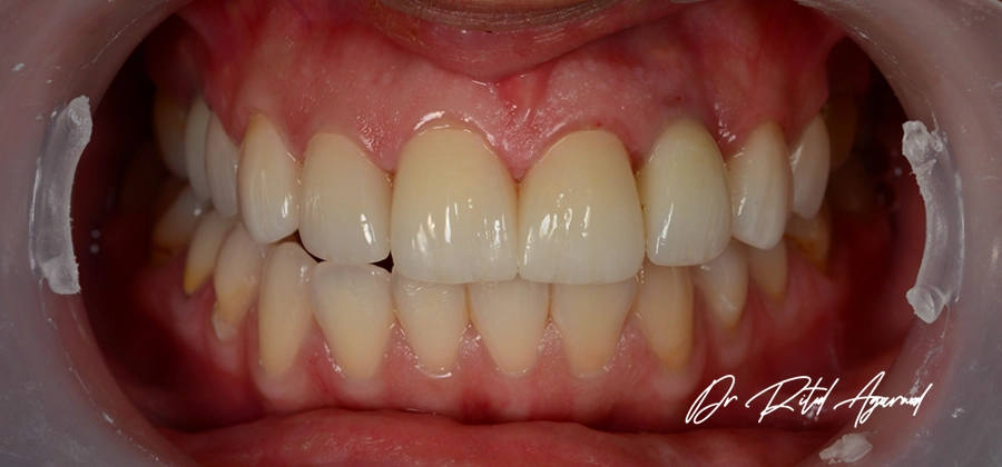 Dr Ritul-Cosmetic Dental Treatment-15