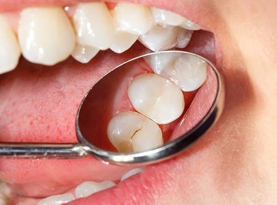 Tooth-colored composite resin dental fillings