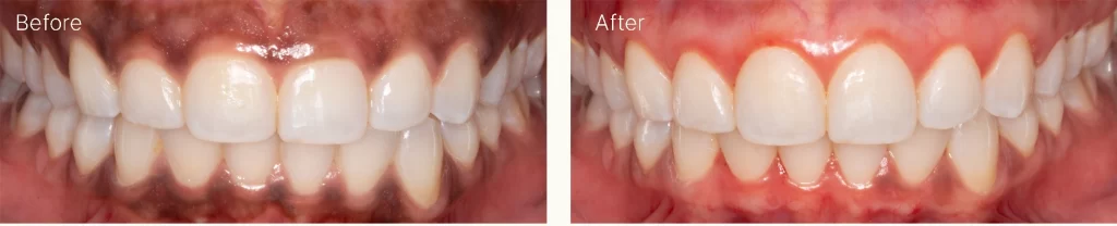 Gum Bleaching - Laser gum depigmentation