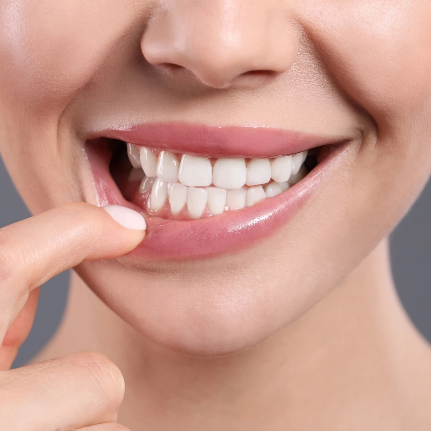 Gum Bleaching in Abu Dhabi : Achieve Natural Pink Gums