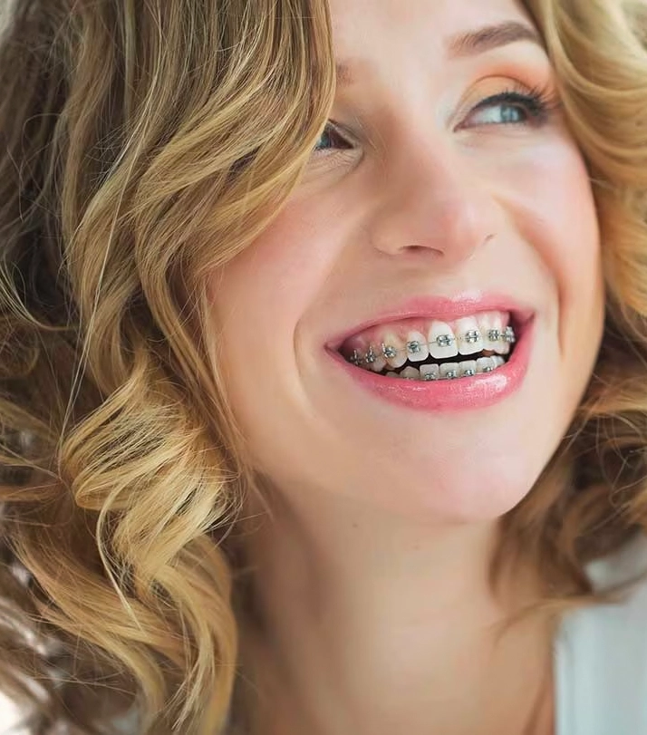 Self Ligating Braces - Effective Orthodontic Solution | ICDE UAE