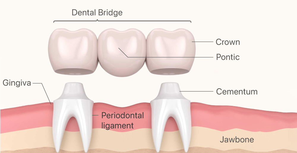 Dental Bridges in Abu Dhabi: Say Goodbye to Gaps