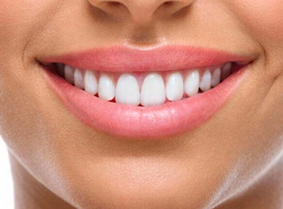 gum contouring - Hollywood Smile treatment