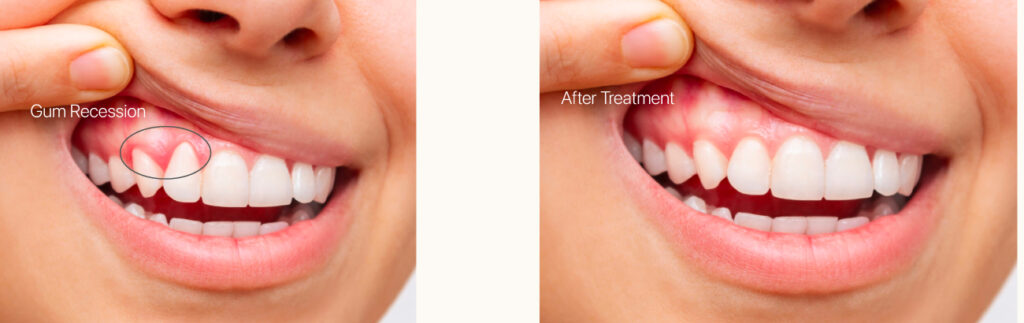receding-gums-Abu-Dhabi