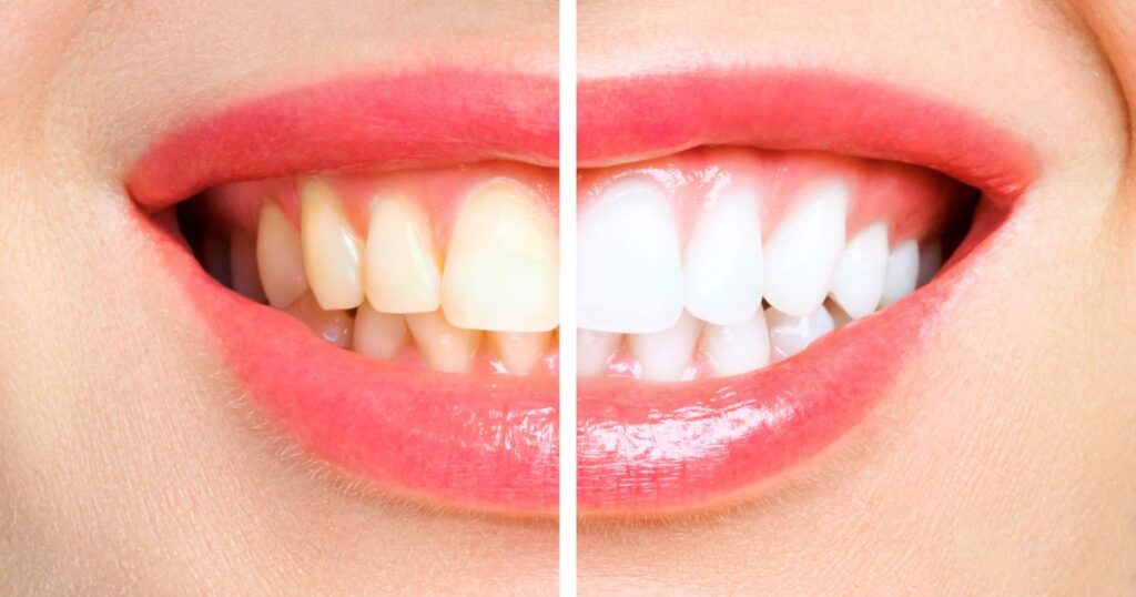 Can yellow teeth become sparkling white again?